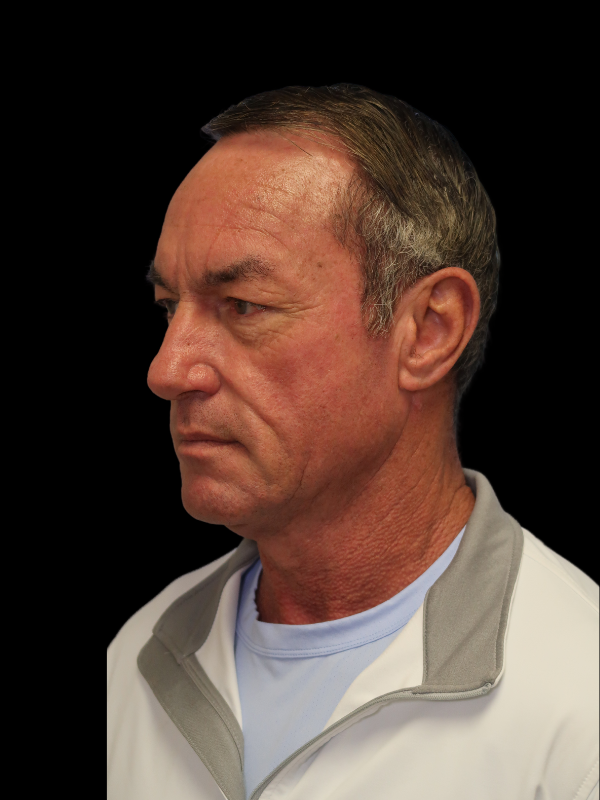 Deep Plane Facelift Gallery Before & After