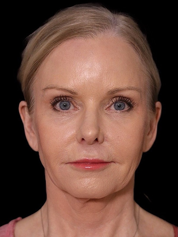 Deep Plane Facelift Gallery Before & After