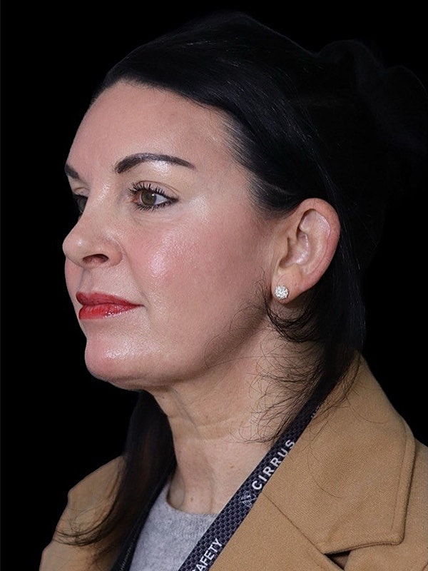 Deep Plane Facelift Gallery Before & After