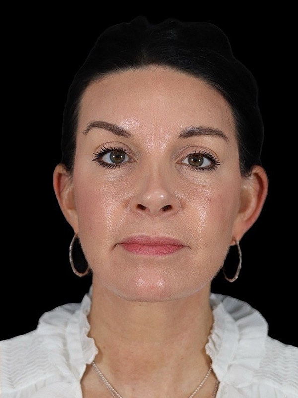 Deep Plane Facelift Gallery Before & After