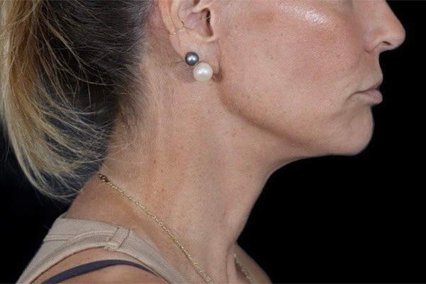 Deep Plane Facelift Gallery Before & After