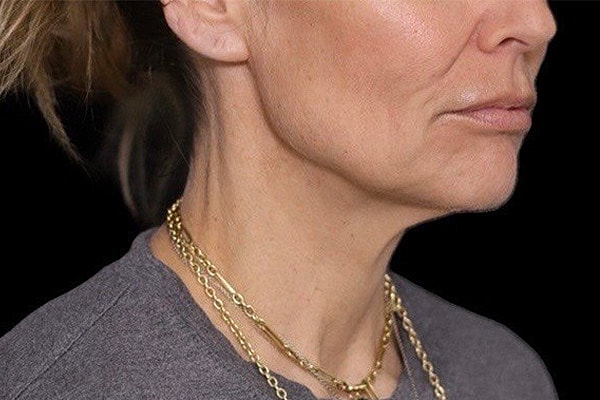 Deep Plane Facelift Gallery Before & After