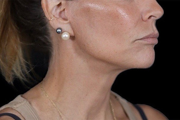 Deep Plane Facelift Gallery Before & After