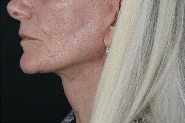 Deep Plane Facelift Gallery Before & After