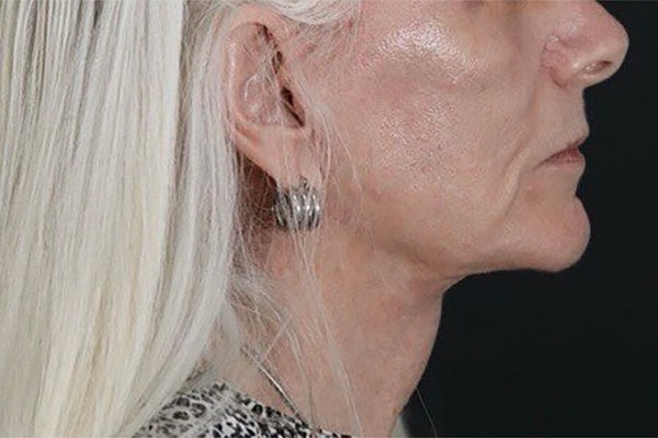 Deep Plane Facelift Gallery Before & After