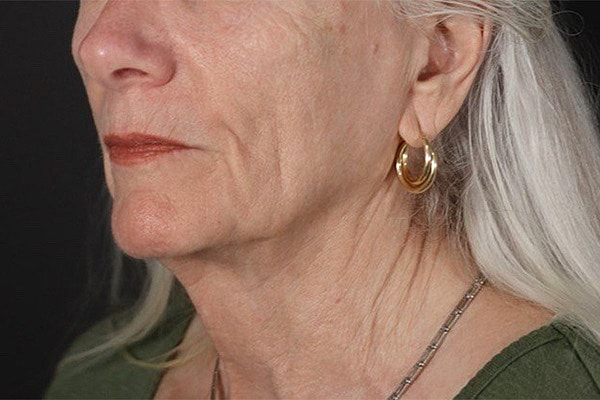 Deep Plane Facelift Gallery Before & After