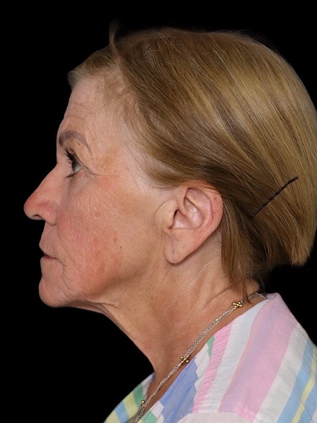 Deep Plane Facelift Gallery Before & After