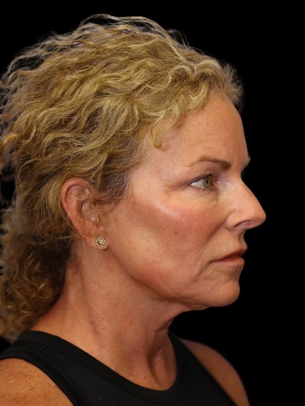 Deep Plane Facelift Gallery Before & After