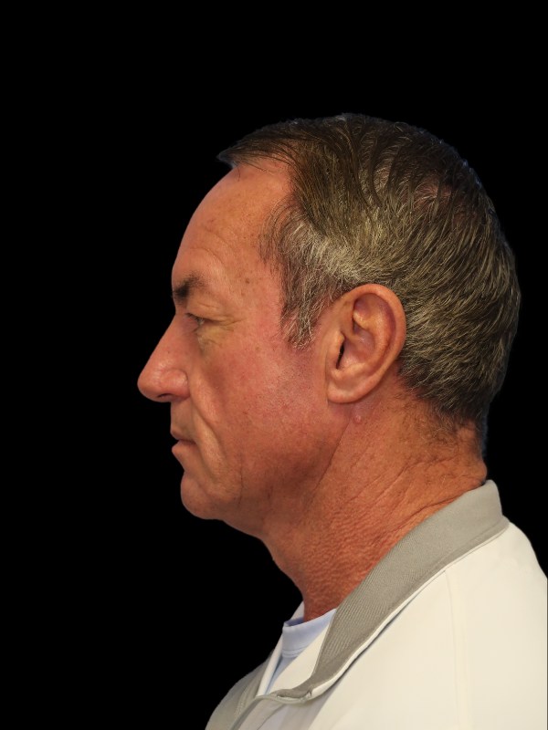 Deep Plane Facelift Gallery Before & After