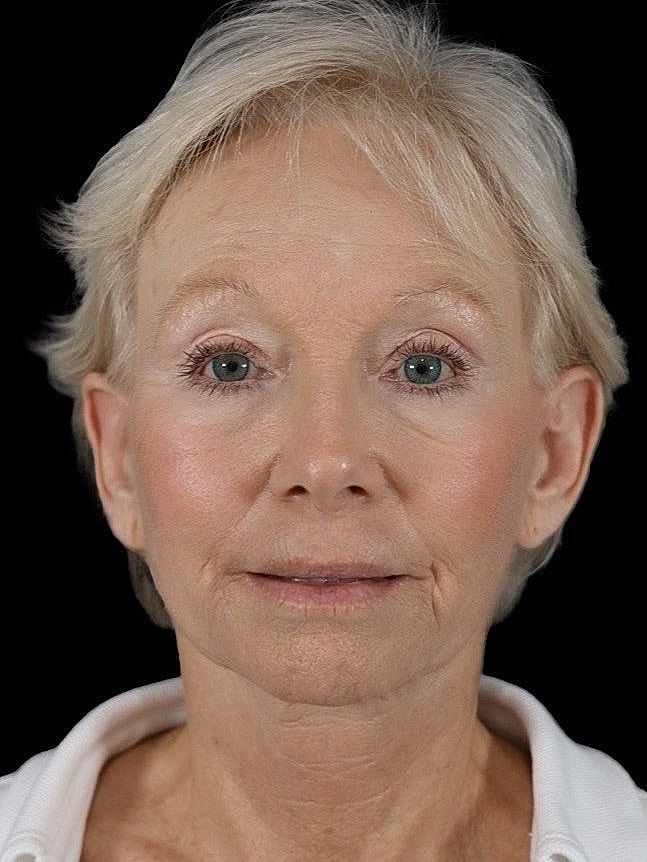 Deep Plane Facelift Gallery Before & After