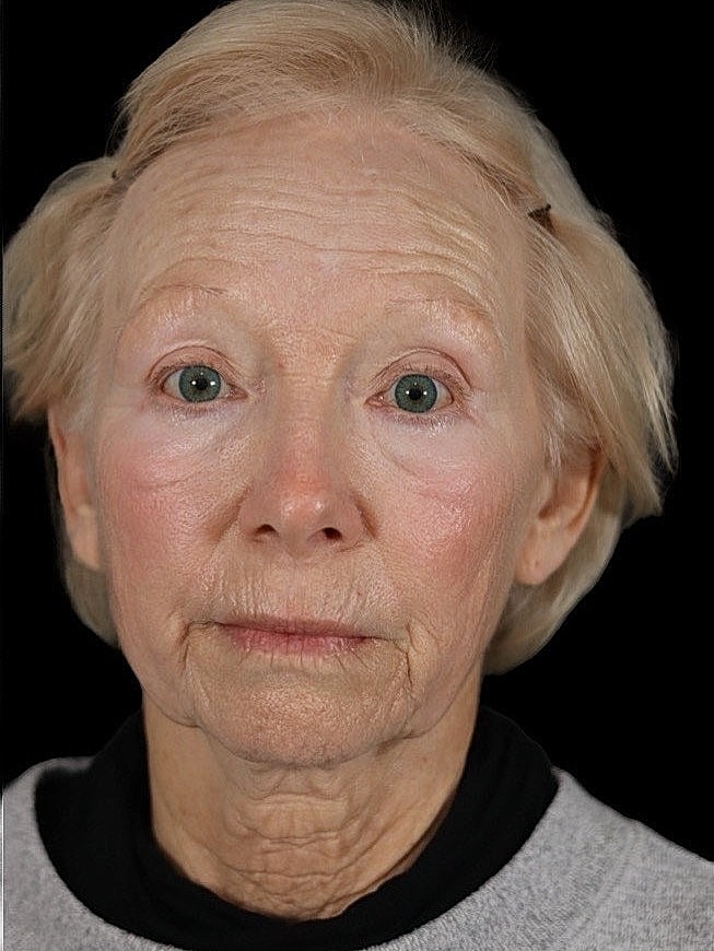 Deep Plane Facelift Gallery Before & After