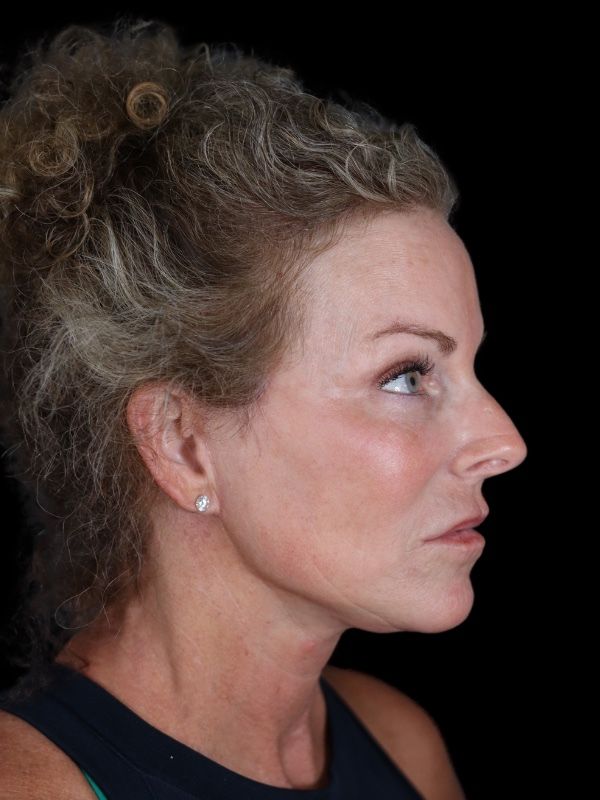 Deep Plane Facelift Gallery Before & After