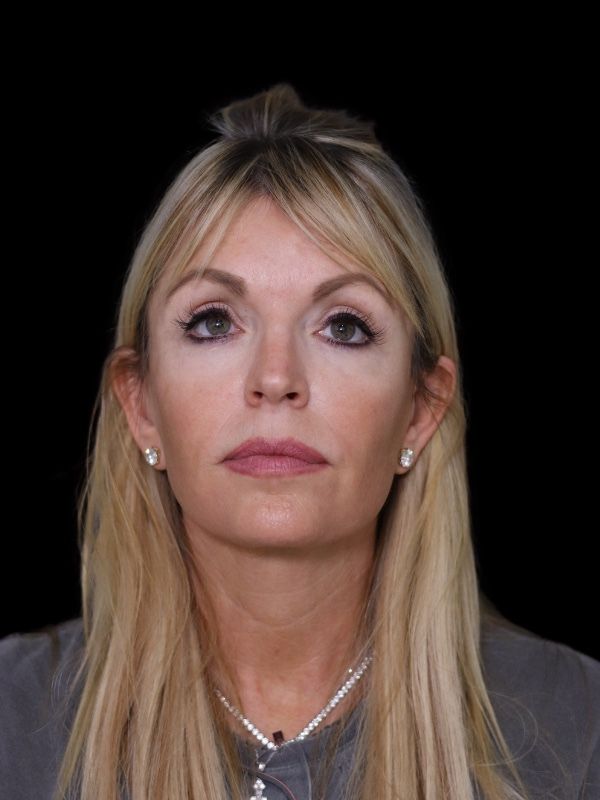 Deep Plane Facelift Gallery Before & After