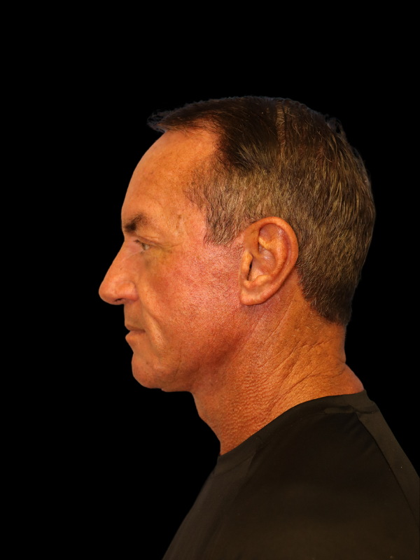 Deep Plane Facelift Gallery Before & After