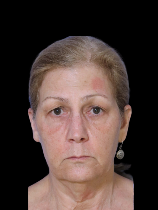 Deep Plane Facelift Gallery Before & After