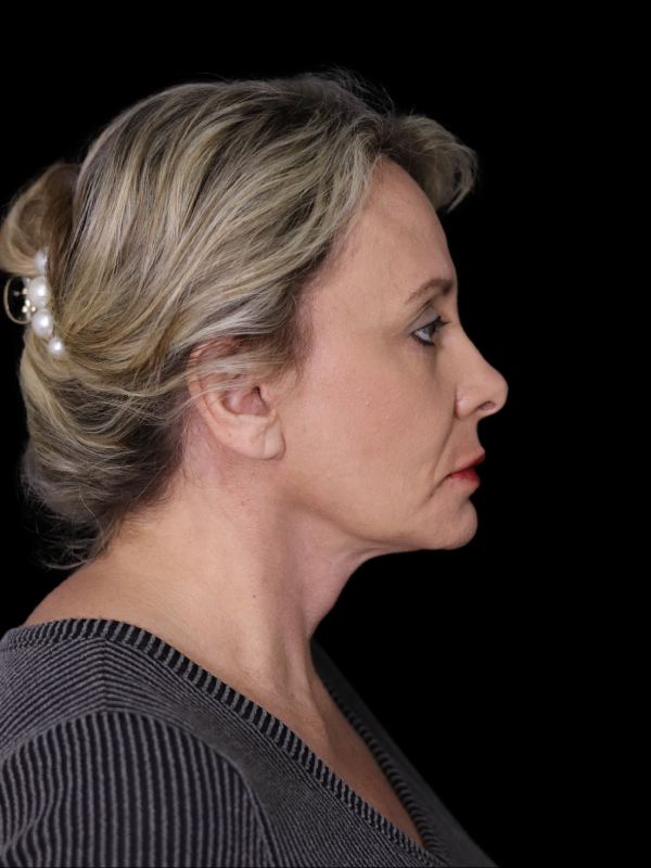 Deep Plane Facelift Gallery Before & After