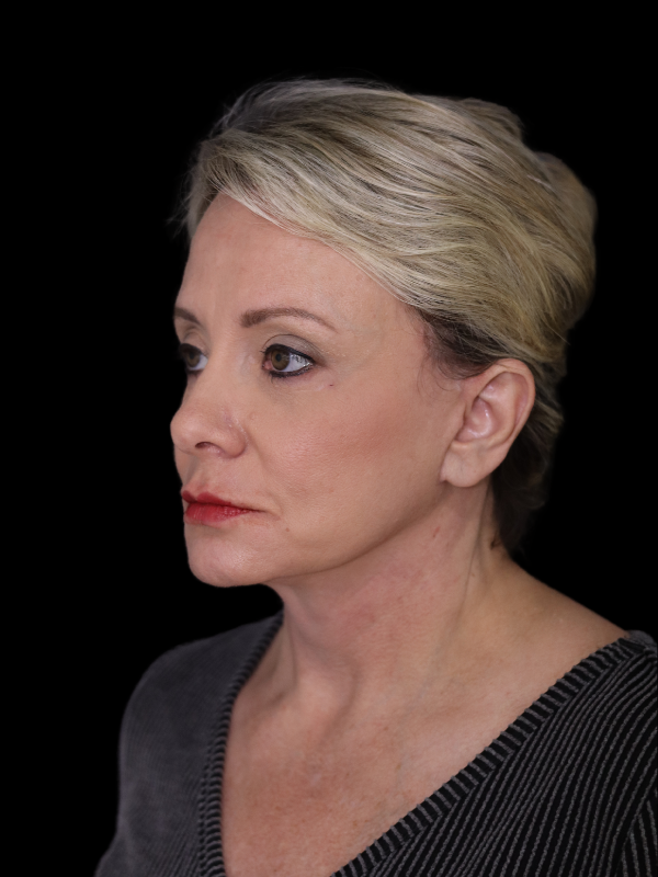 Deep Plane Facelift Gallery Before & After