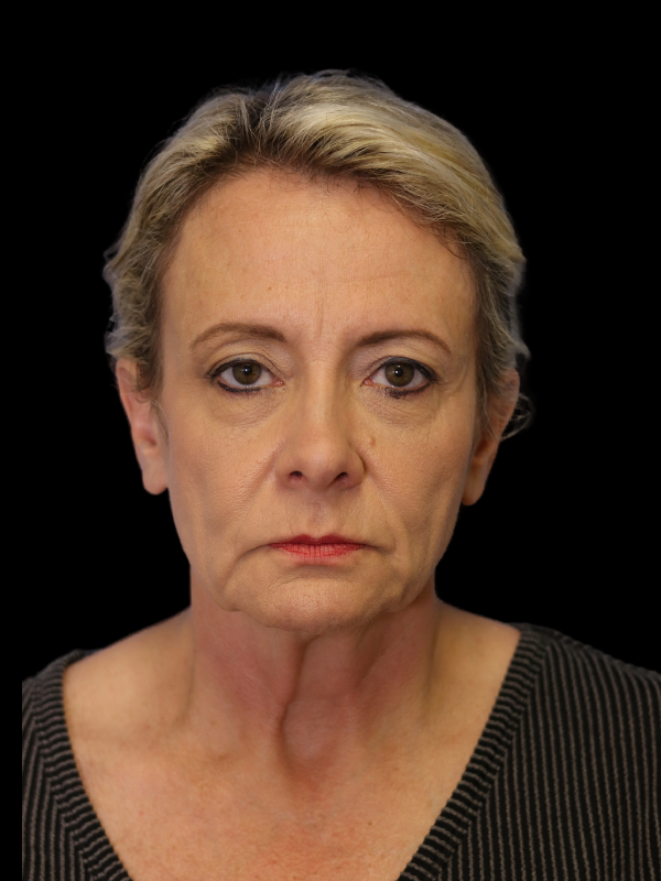 Deep Plane Facelift Gallery Before & After