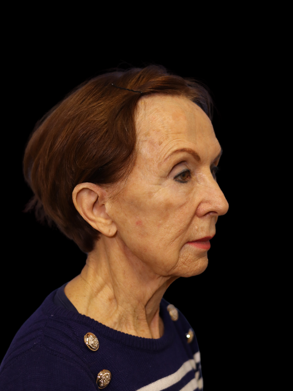 Deep Plane Facelift Gallery Before & After