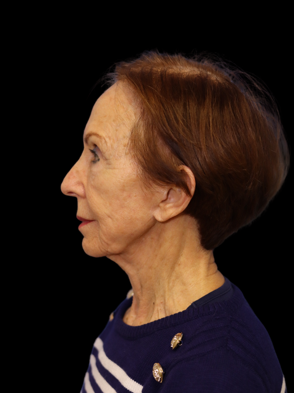 Deep Plane Facelift Gallery Before & After