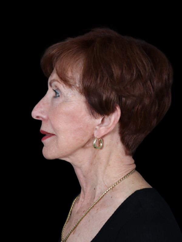 Deep Plane Facelift Gallery Before & After