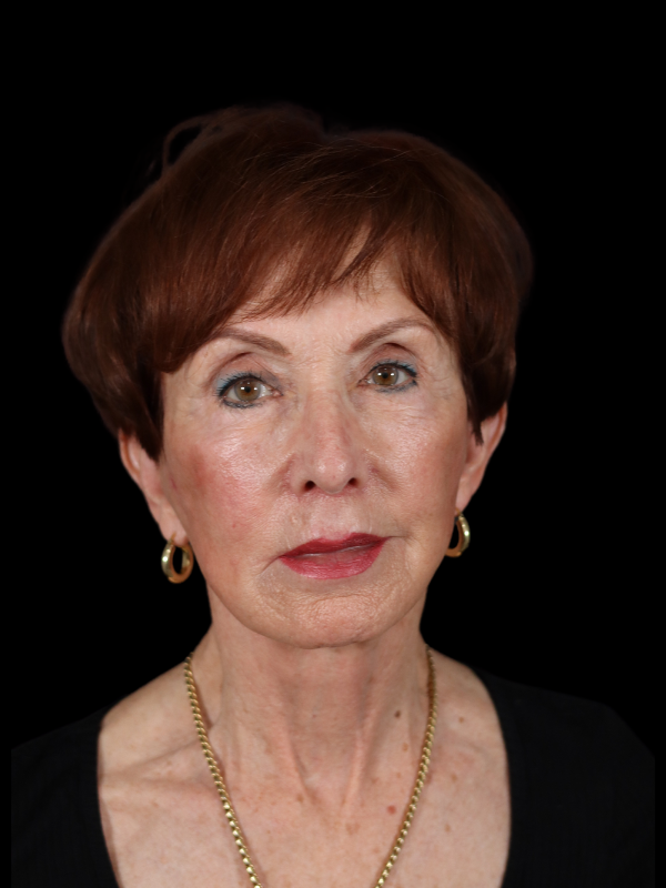 Deep Plane Facelift Gallery Before & After