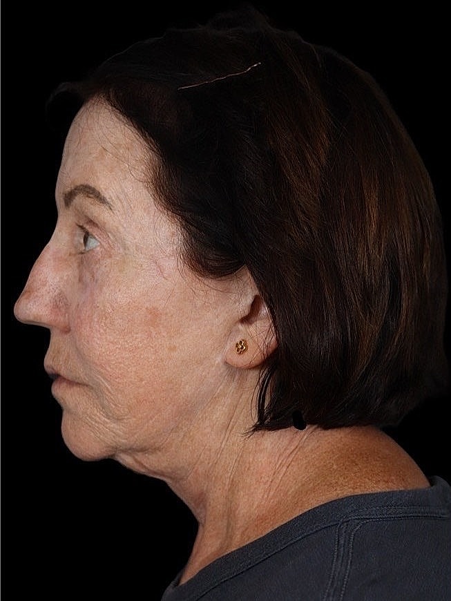 Deep Plane Facelift Gallery Before & After