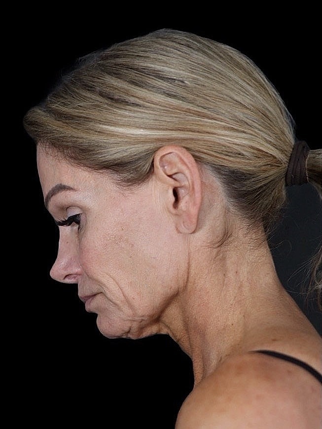Deep Plane Facelift Gallery Before & After