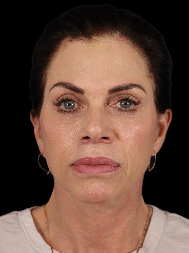 Deep Plane Facelift Gallery Before & After