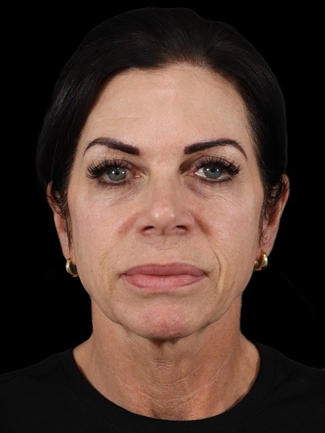 Deep Plane Facelift Gallery Before & After