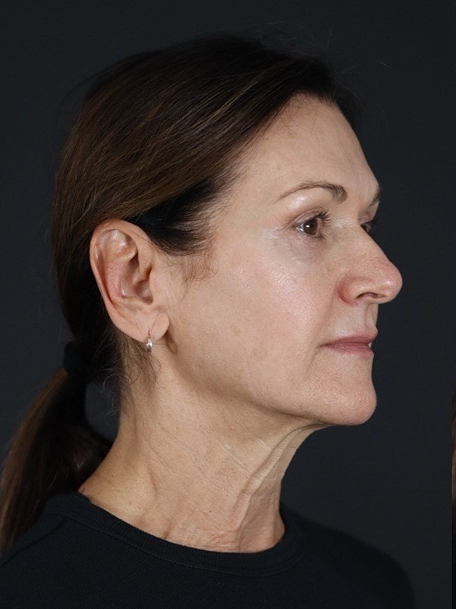 Deep Plane Facelift Gallery Before & After