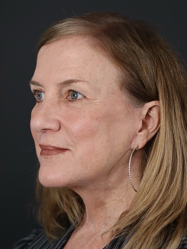 Deep Plane Facelift Gallery Before & After