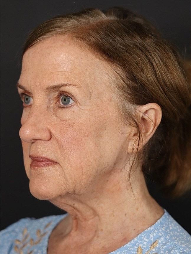 Deep Plane Facelift Gallery Before & After