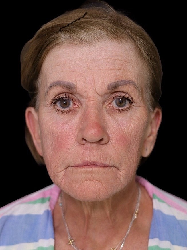 Deep Plane Facelift Gallery Before & After