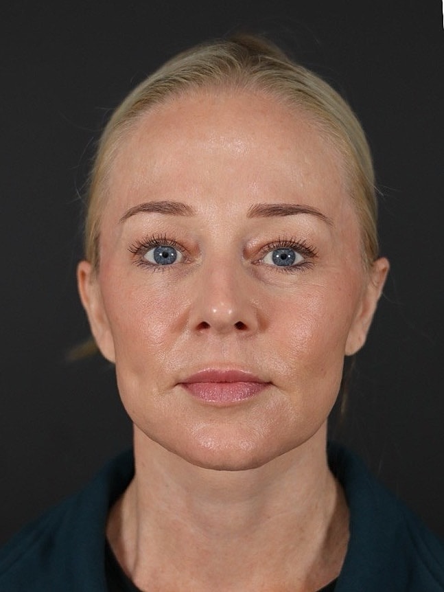 Deep Plane Facelift Gallery Before & After