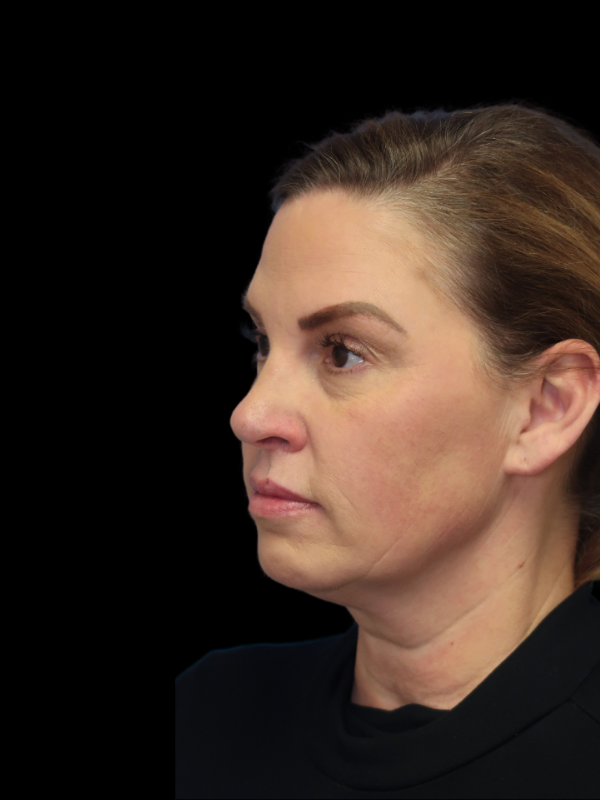 Deep Plane Facelift Gallery Before & After