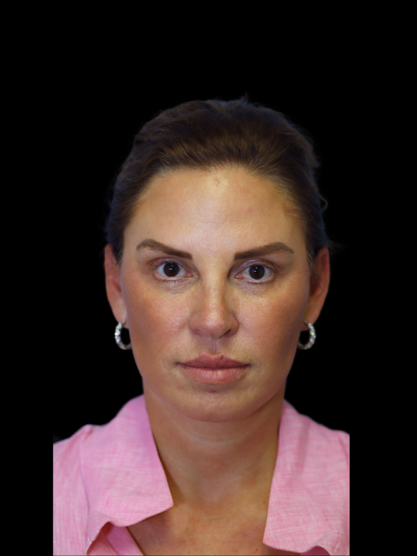 Deep Plane Facelift Gallery Before & After