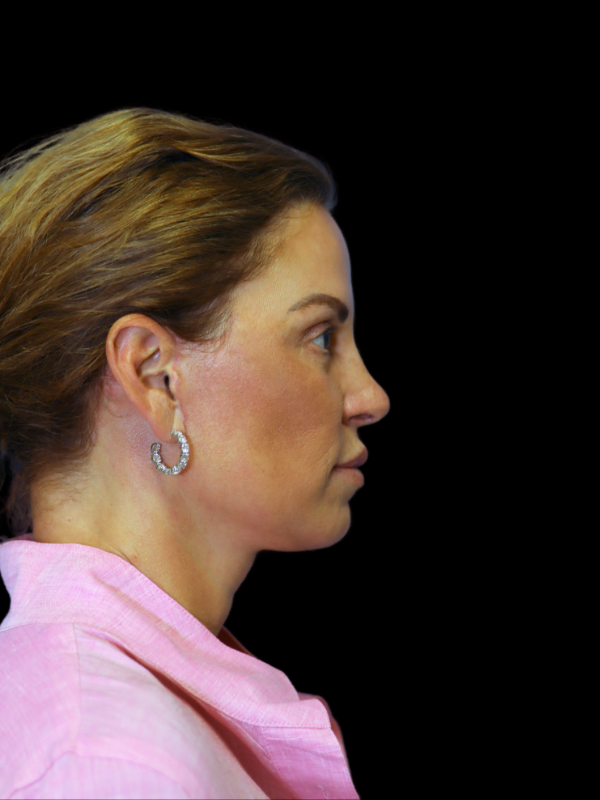 Deep Plane Facelift Gallery Before & After