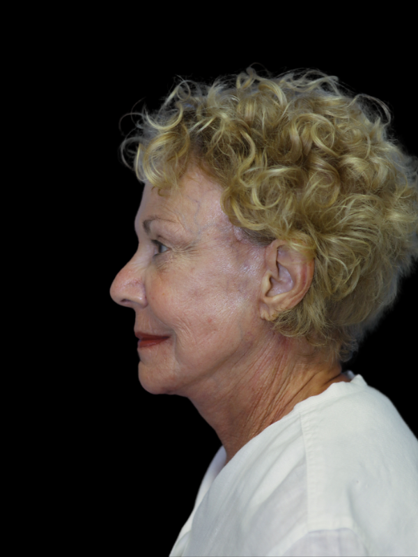 Deep Plane Facelift Gallery Before & After