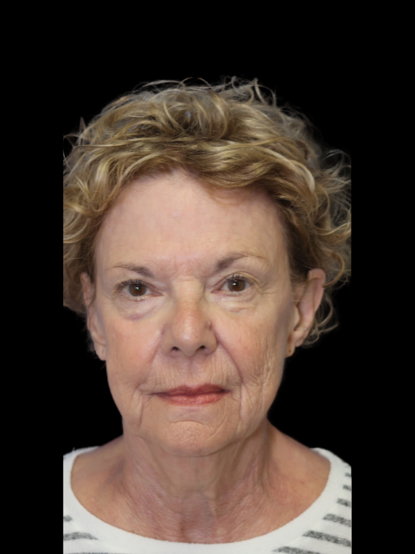 Deep Plane Facelift Gallery Before & After