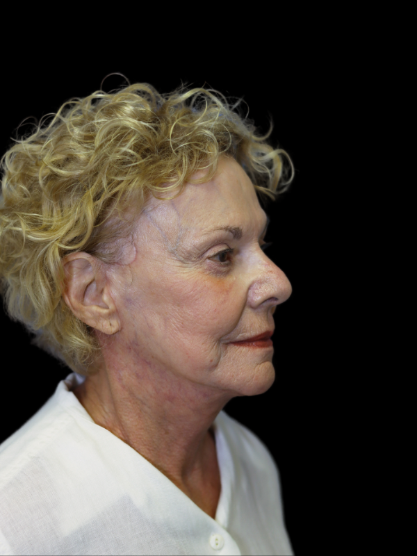 Deep Plane Facelift Gallery Before & After