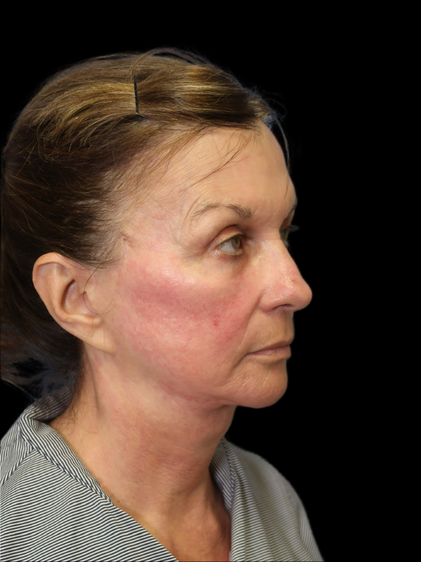 Deep Plane Facelift Gallery Before & After