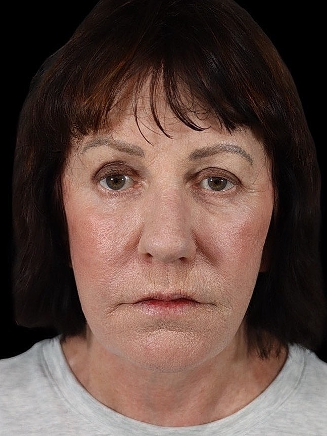 Deep Plane Facelift Gallery Before & After