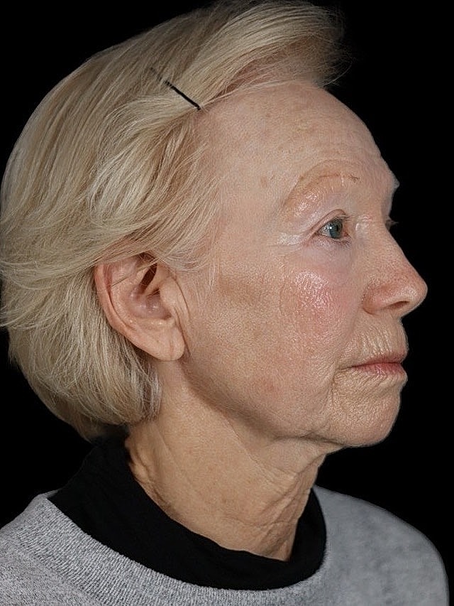 Deep Plane Facelift Gallery Before & After