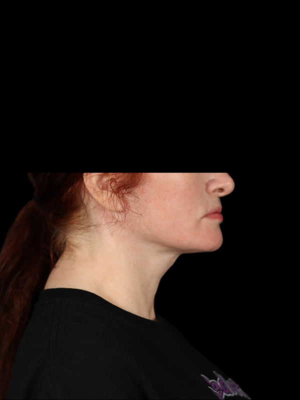 Deep Plane Facelift Gallery Before & After