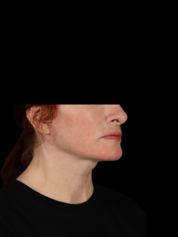 Deep Plane Facelift Gallery Before & After