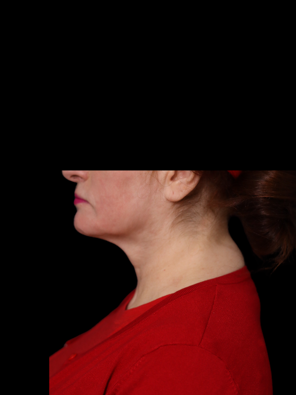 Deep Plane Facelift Gallery Before & After