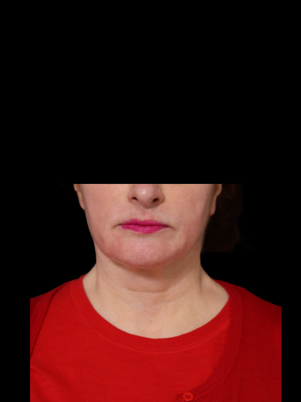 Deep Plane Facelift Gallery Before & After