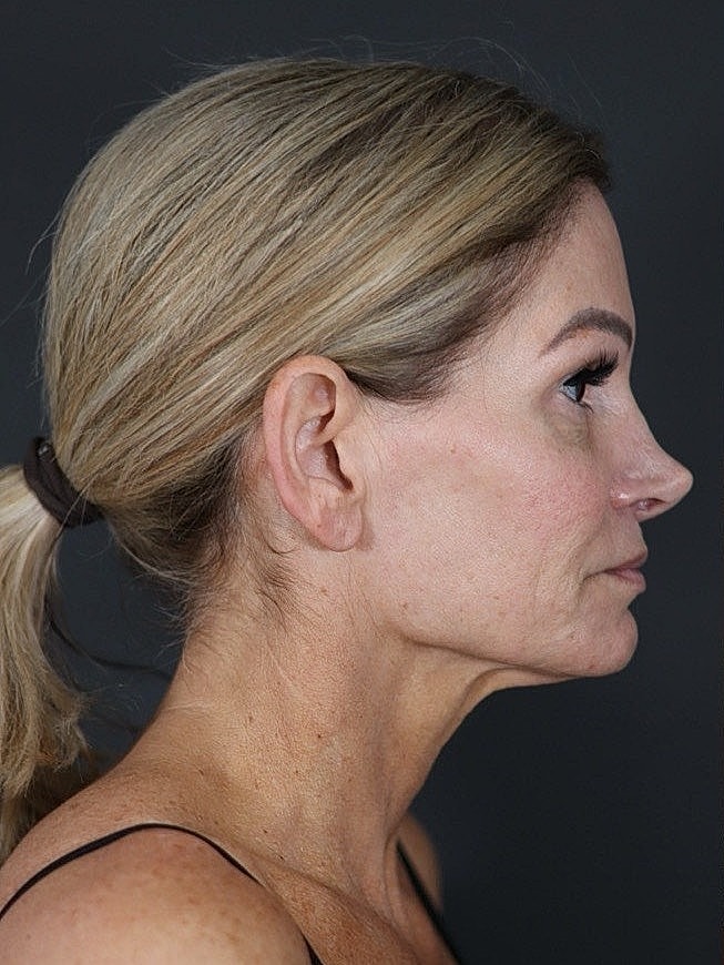 Deep Plane Facelift Gallery Before & After