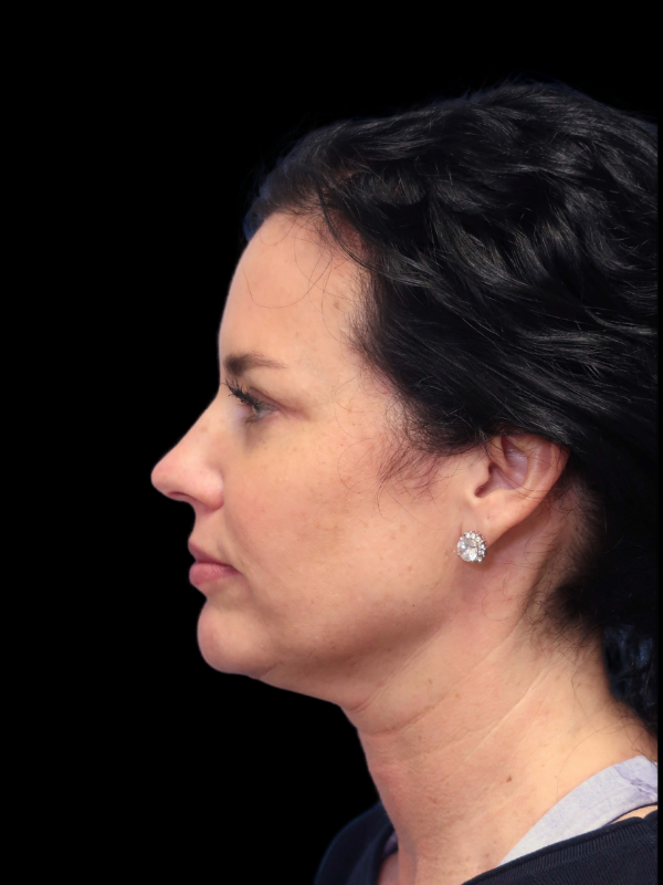 Deep Plane Facelift Gallery Before & After